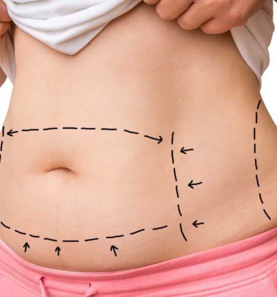 What is liposuction and how is it done